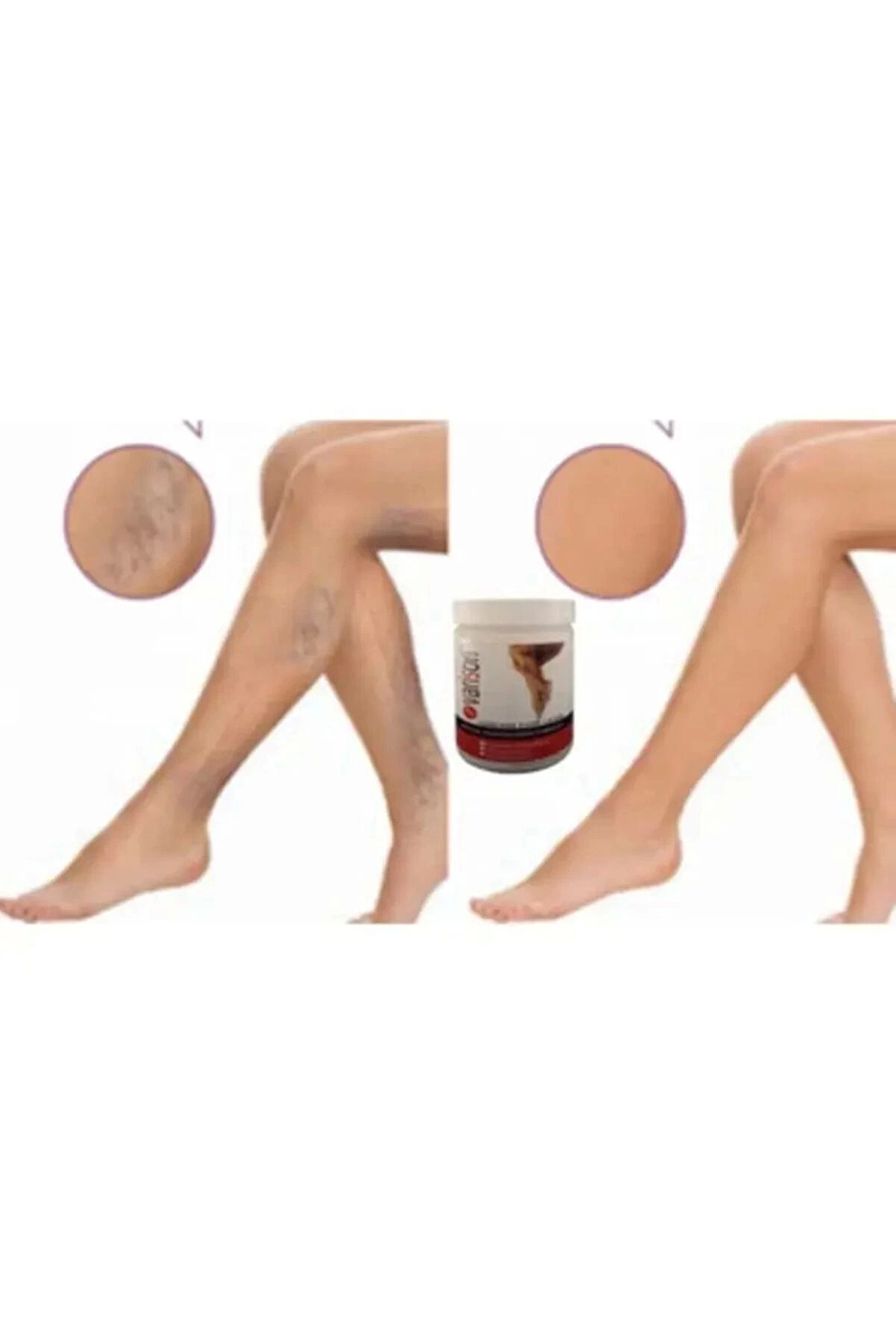 Adoi̇l Kremi̇ 200Ml / Vari̇son Vari̇cose Vei̇ns Cream 200Ml X 3 Adet