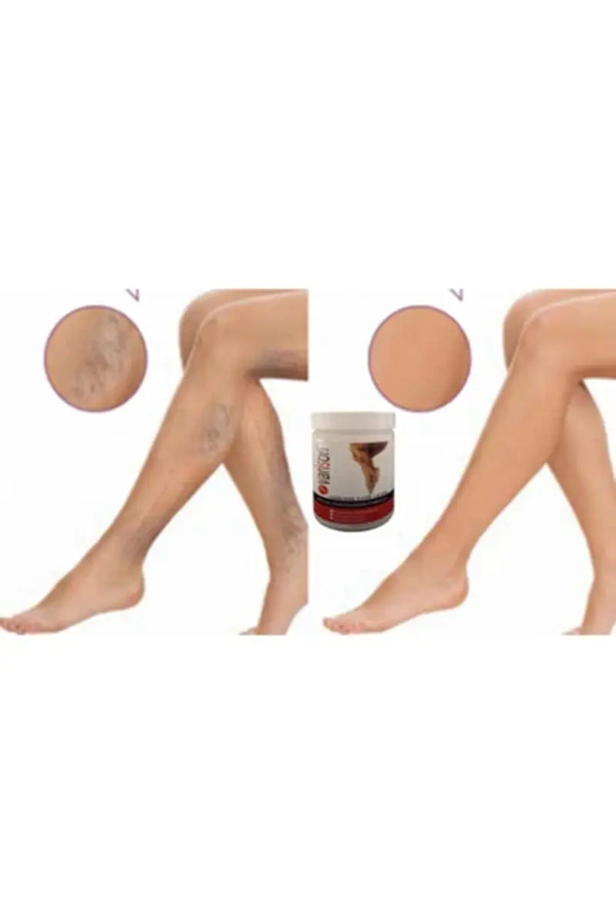 Adoi̇l Kremi̇ 200Ml / Vari̇son Vari̇cose Vei̇ns Cream 200Ml X 2 Adet