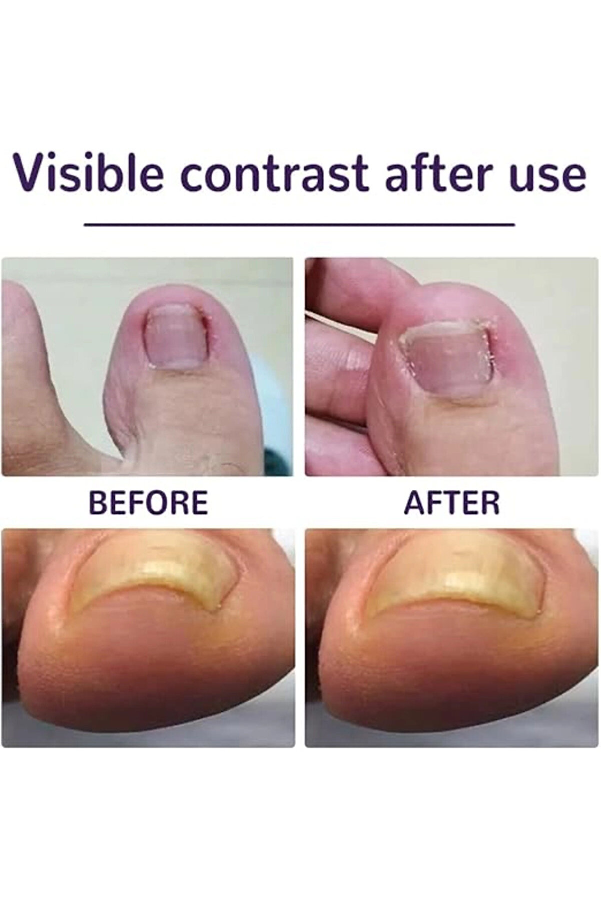 Ayak Tırnağı Düzeltme Bandı 50 Adet