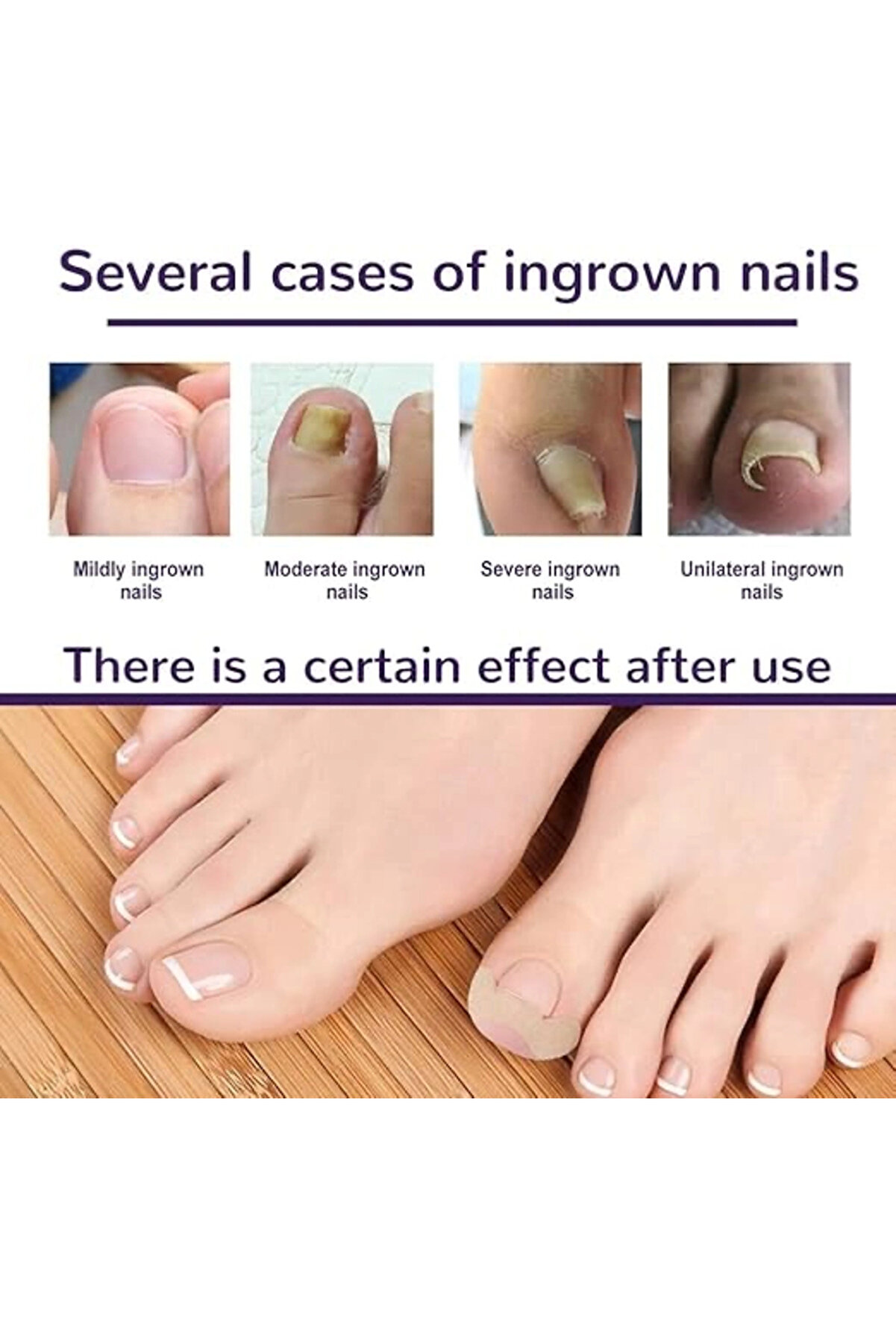 Ayak Tırnağı Düzeltme Bandı 50 Adet