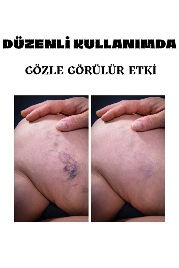 Vari̇cose Vei̇ns Var.i̇s Kremi̇ 100 Ml